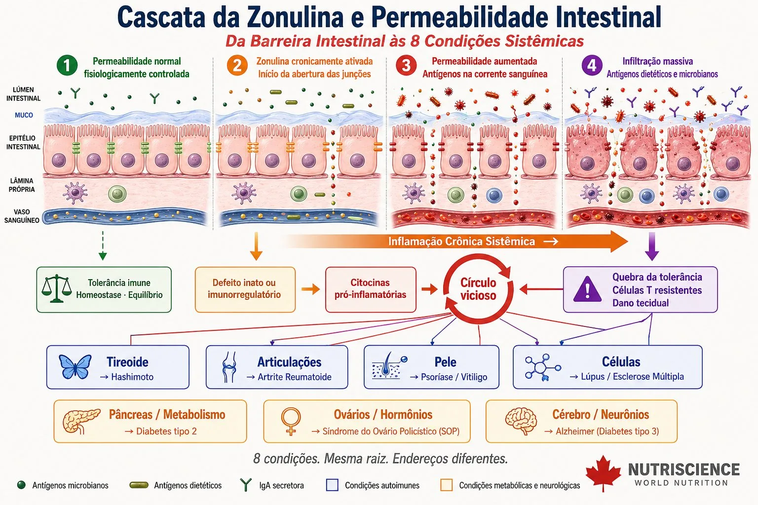 Infográfico científico mostrando a cascata da zonulina em 4 estágios progressivos de permeabilidade intestinal e as 8 condições sistêmicas associadas: Hashimoto, Artrite Reumatoide, Psoríase, Lúpus, Esclerose Múltipla, Diabetes tipo 2, SOP e Alzheimer